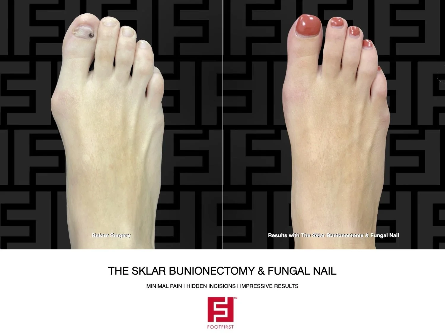 Popular Winter Procedures for your Feet! — Foot First Podiatry Centers